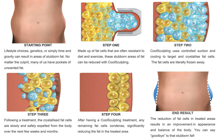What is Coolsculpting