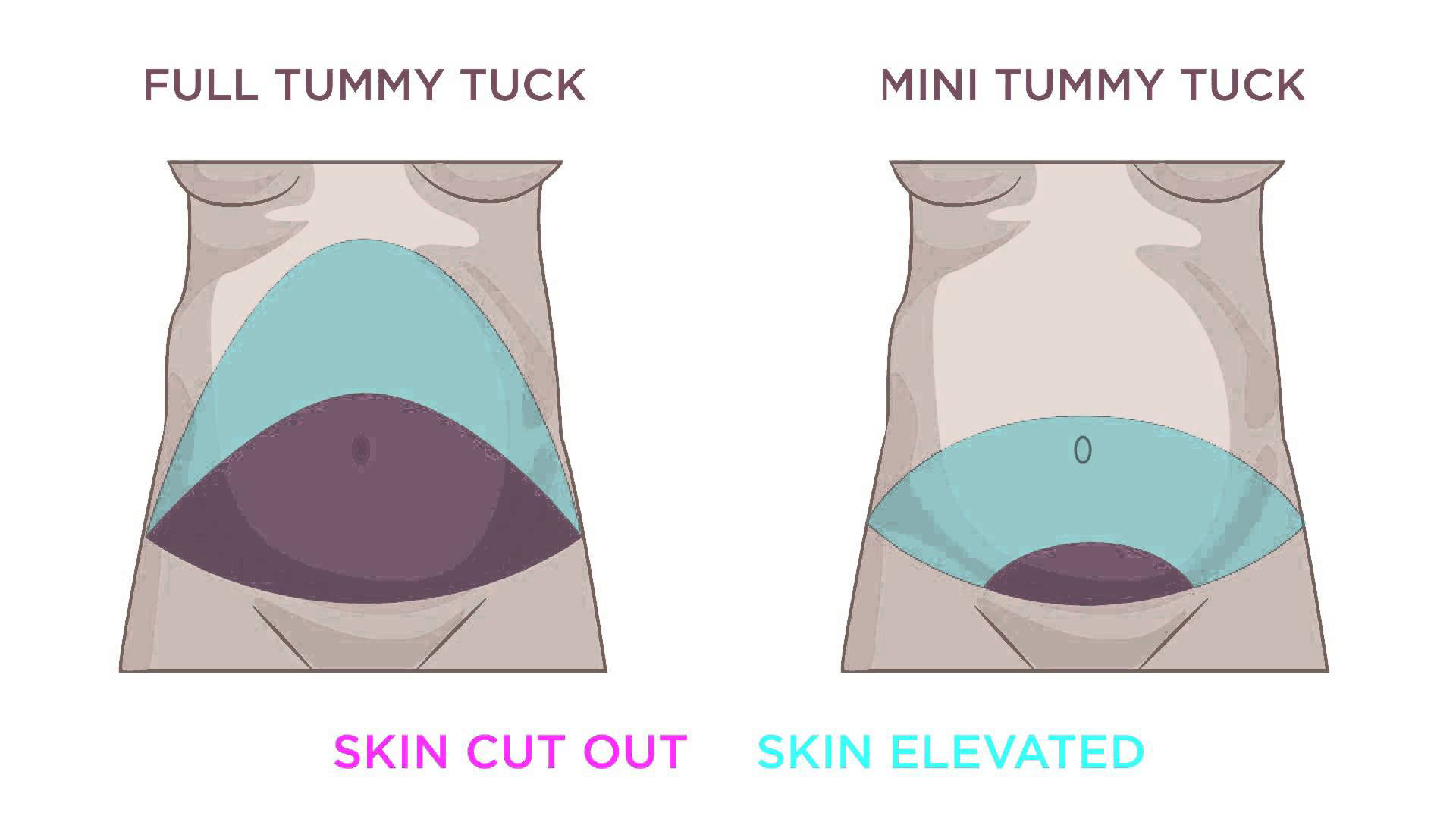 Difference between Mini Tummy Tuck and Tummy Tuck - Austin TX