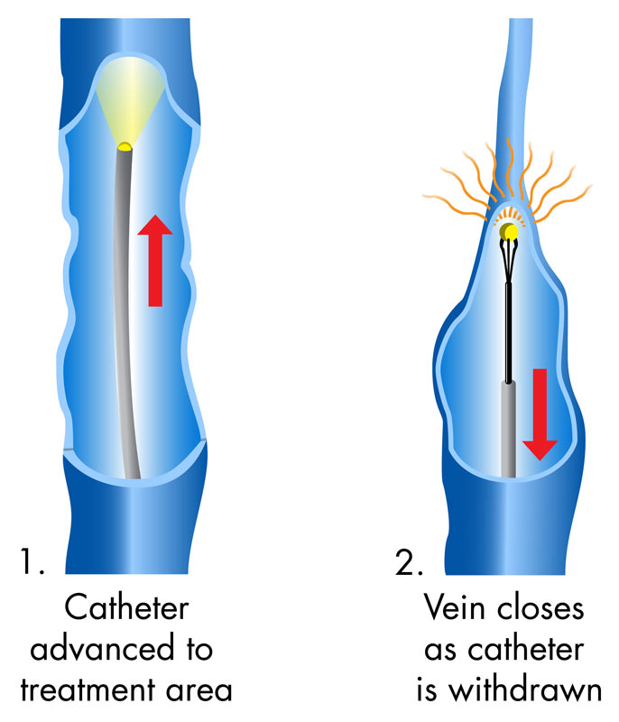 varicose vein treatment